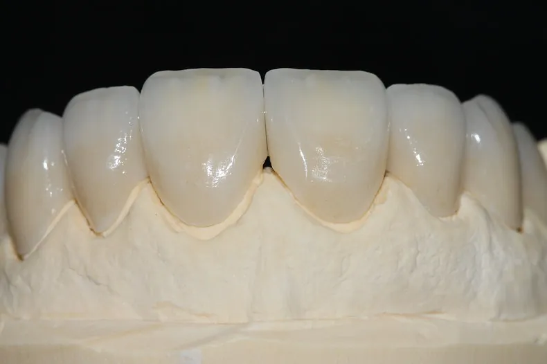 Acabamento manual de coroa de zircônia no PHI Dental Lab